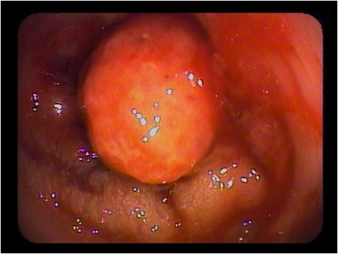 Colon GI Photo Gallery diagram for colon cancer colon 